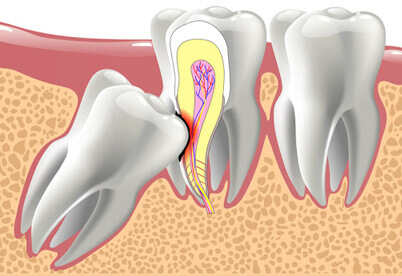 Extractions-Preservation_img
