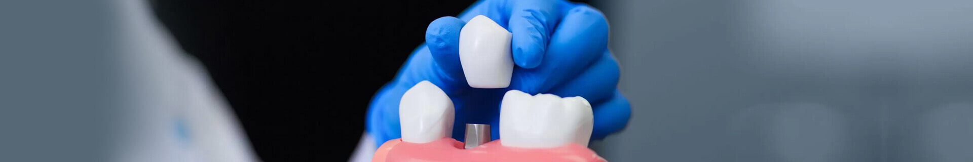 banner-dental-implant