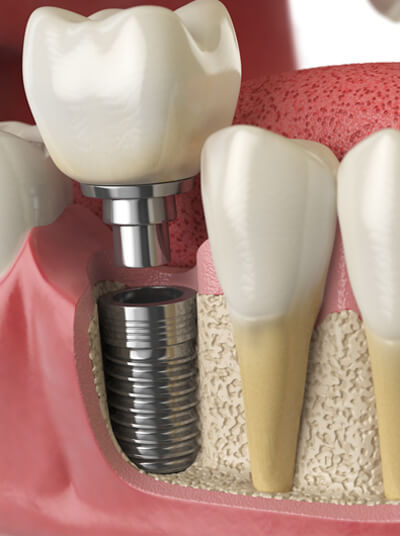 dental implant_image