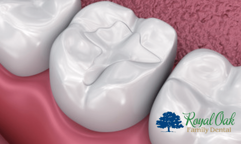 Aftercare Tips To Keep Dental Sealants Strong And Healthy