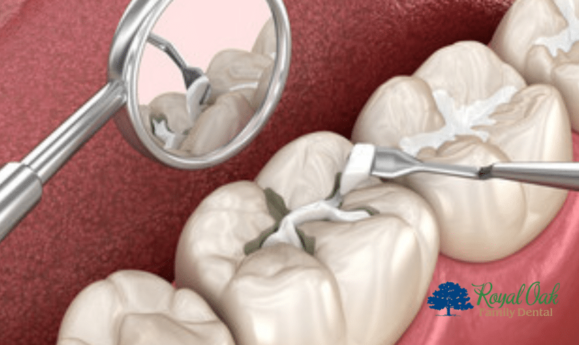 Taking Care Of Your Teeth After Fillings
