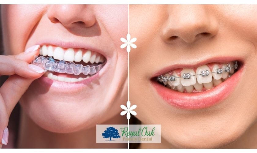 Why is Invisalign Faster than Braces? The Key to a Speedy Smile Makeover