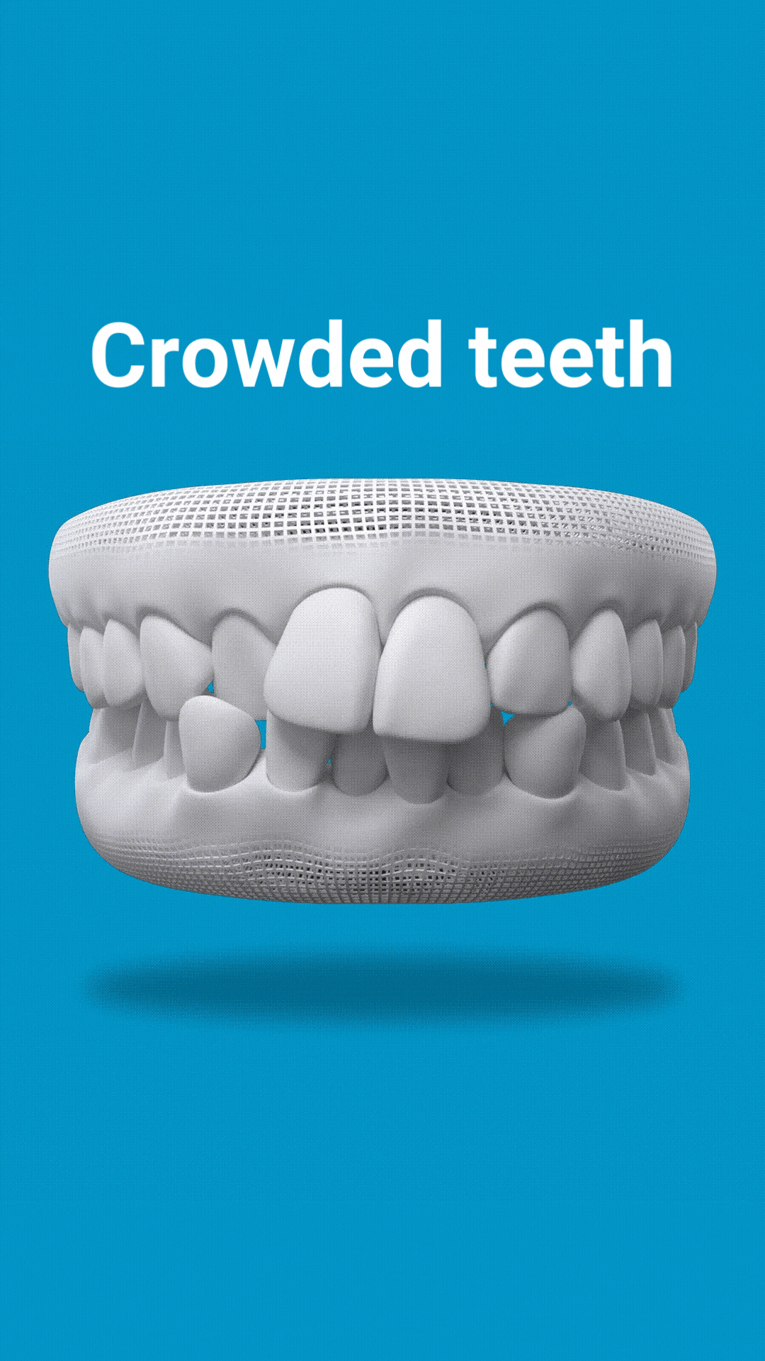 Crowded-teeth