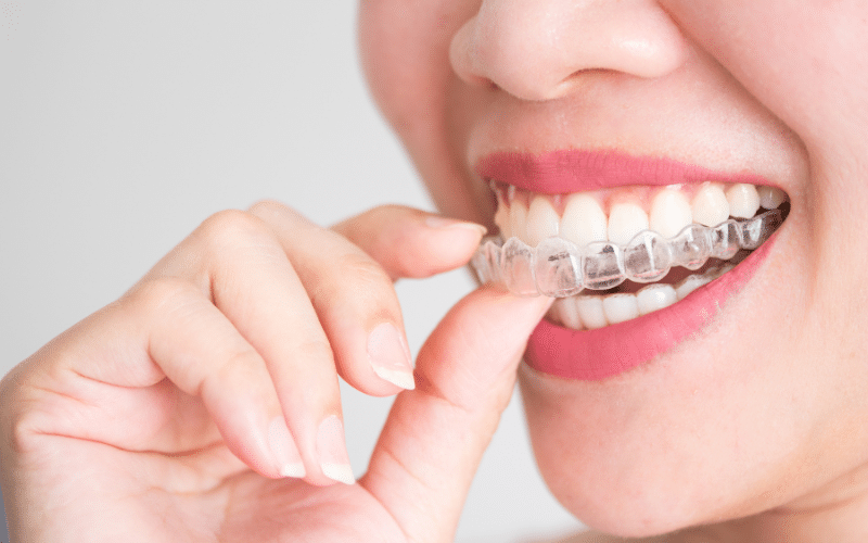 Stages of Invisalign Movement