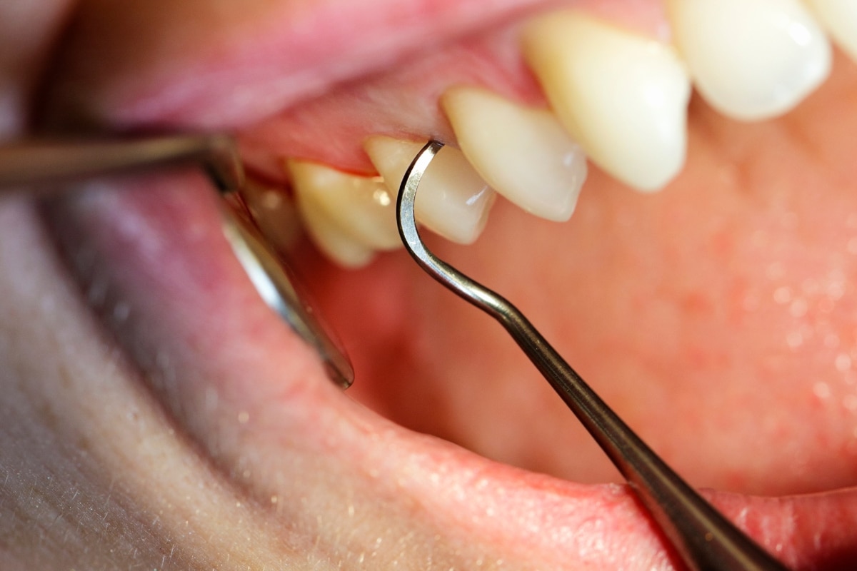 signs of poor oral hygiene