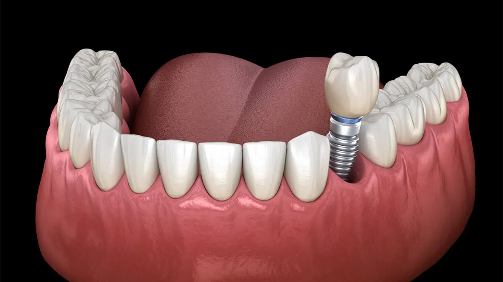 dental_implants_diagram